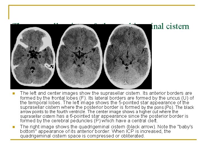 The suprasellar cistern & the quadrigeminal cistern n The left and center images show