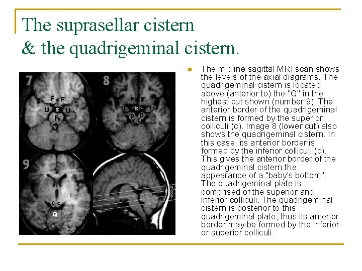 The suprasellar cistern & the quadrigeminal cistern. n The midline sagittal MRI scan shows