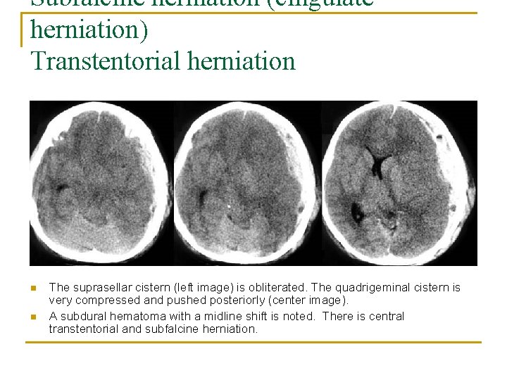 Subfalcine herniation (cingulate herniation) Transtentorial herniation n n The suprasellar cistern (left image) is
