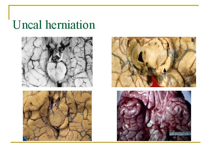 Uncal herniation 