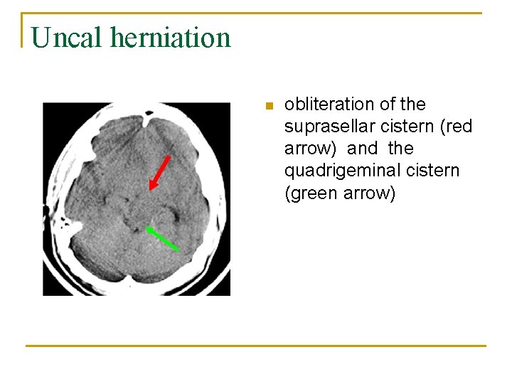 Uncal herniation n obliteration of the suprasellar cistern (red arrow) and the quadrigeminal cistern