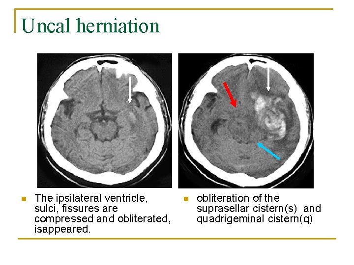 Uncal herniation n The ipsilateral ventricle, sulci, fissures are compressed and obliterated, isappeared. n