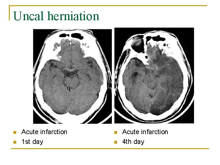 Uncal herniation s q n n Acute infarction 1 st day n n Acute