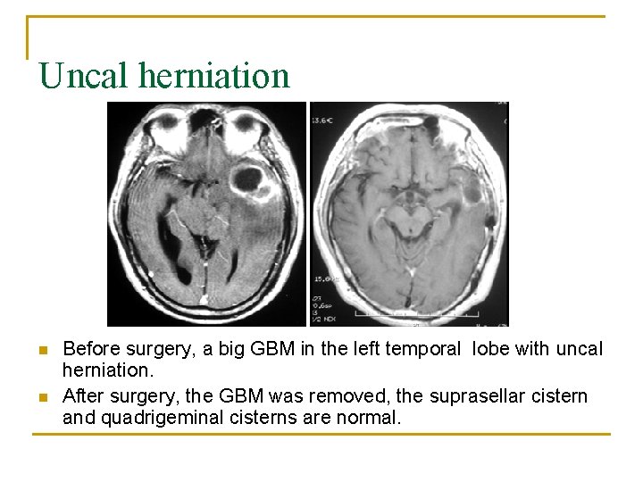 Uncal herniation n n Before surgery, a big GBM in the left temporal lobe
