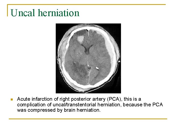 Uncal herniation n Acute infarction of right posterior artery (PCA), this is a complication