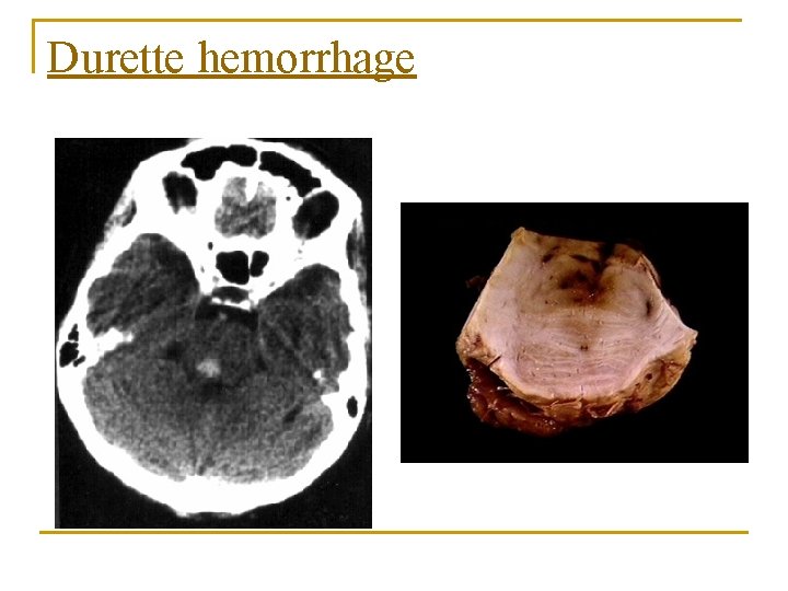 Durette hemorrhage 