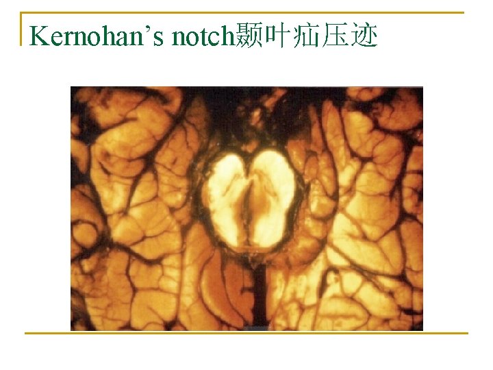 Kernohan’s notch颞叶疝压迹 