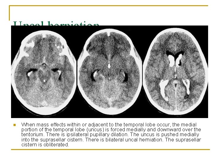 Uncal herniation n When mass effects within or adjacent to the temporal lobe occur,