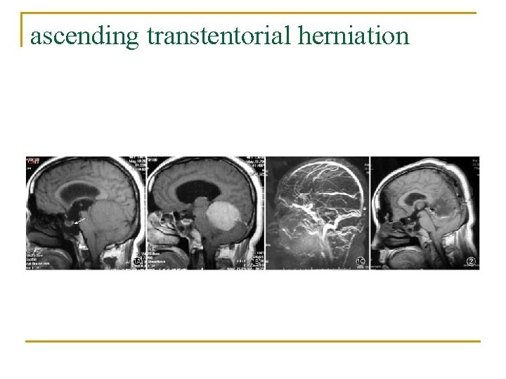 ascending transtentorial herniation 