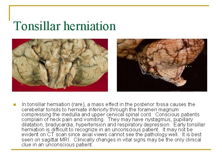 Tonsillar herniation n In tonsillar herniation (rare), a mass effect in the posterior fossa