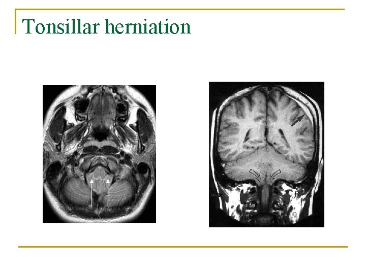 Tonsillar herniation 