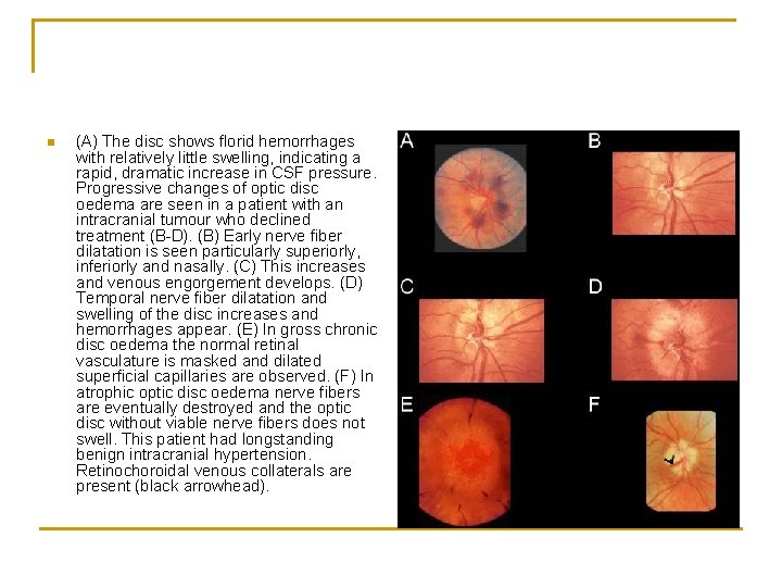 n (A) The disc shows florid hemorrhages with relatively little swelling, indicating a rapid,