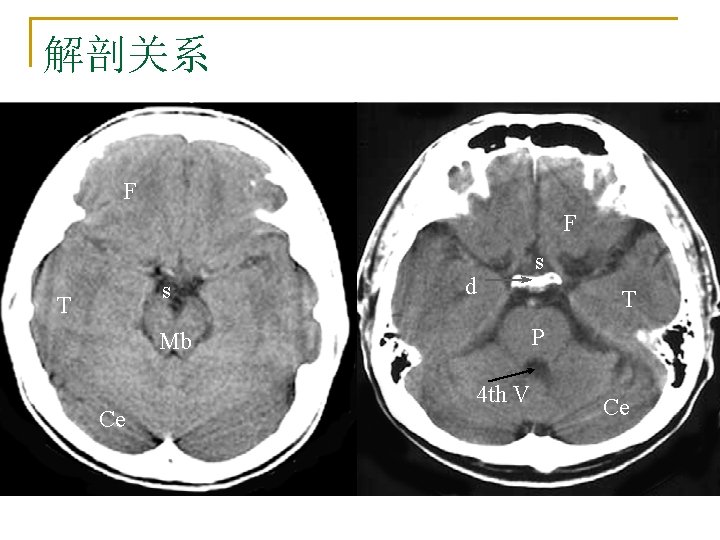 解剖关系 F F s T d T P Mb Ce s 4 th V