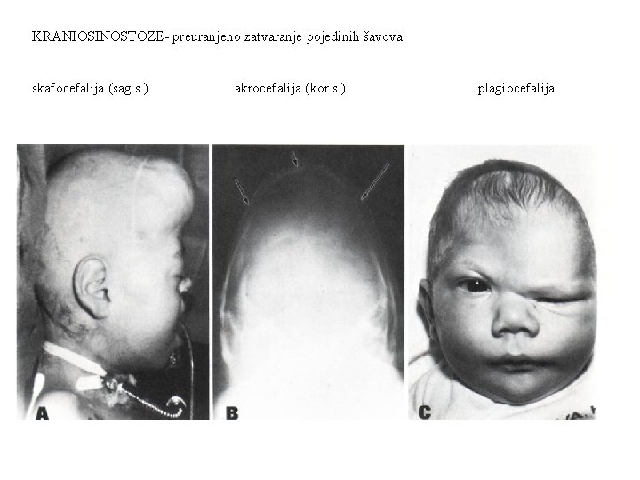 KRANIOSINOSTOZE- preuranjeno zatvaranje pojedinih šavova skafocefalija (sag. s. ) akrocefalija (kor. s. ) plagiocefalija