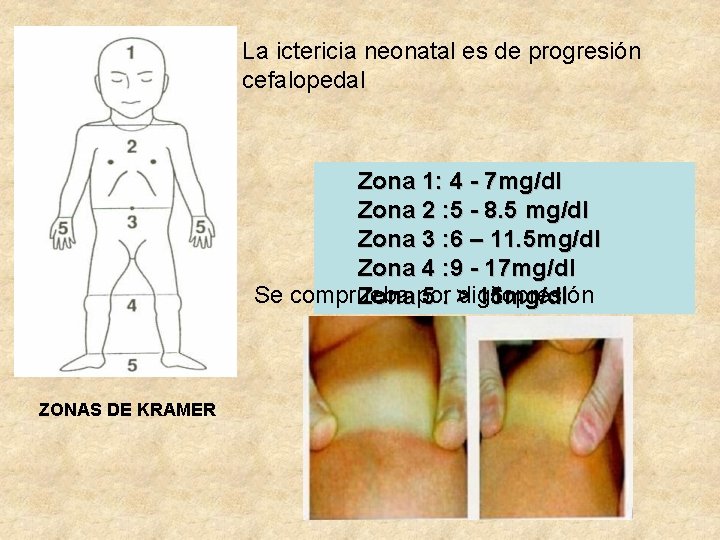 La ictericia neonatal es de progresión cefalopedal Zona 1: 4 - 7 mg/dl Zona