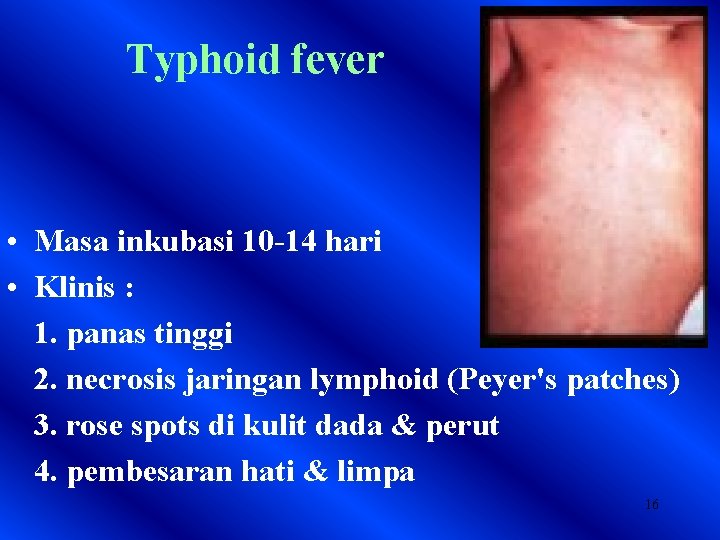 Typhoid fever • Masa inkubasi 10 -14 hari • Klinis : 1. panas tinggi