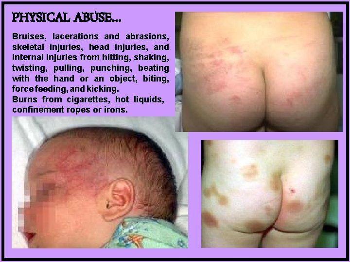 PHYSICAL ABUSE… Bruises, lacerations and abrasions, skeletal injuries, head injuries, and internal injuries from