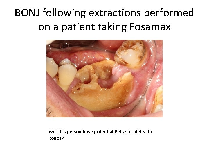 BONJ following extractions performed on a patient taking Fosamax Will this person have potential
