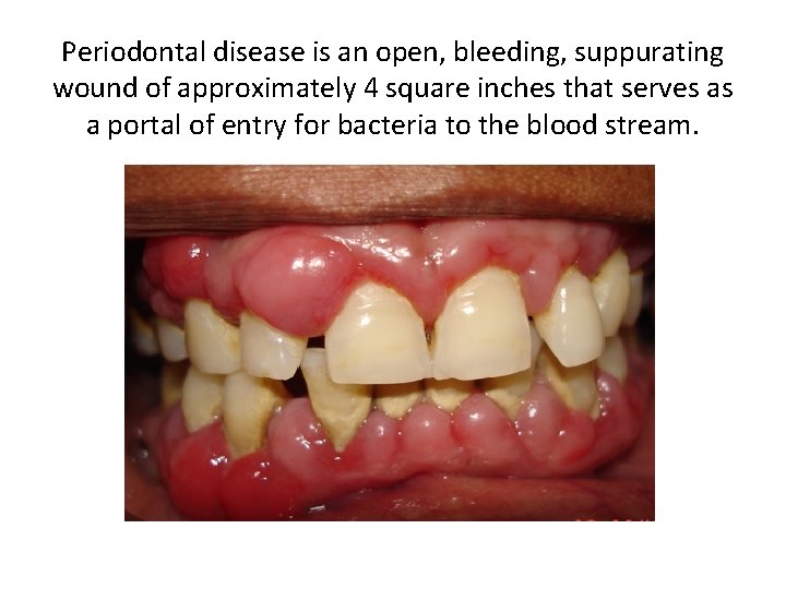 Periodontal disease is an open, bleeding, suppurating wound of approximately 4 square inches that