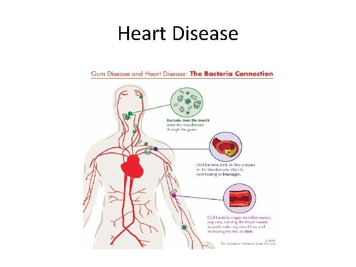 Heart Disease 