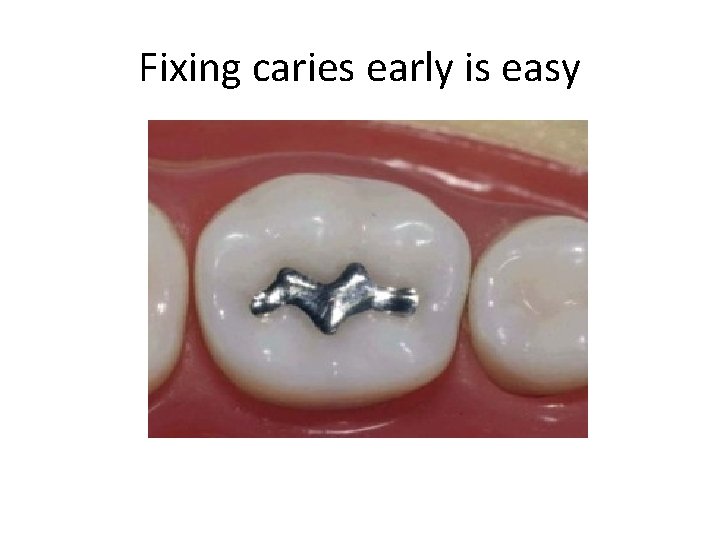 Fixing caries early is easy 
