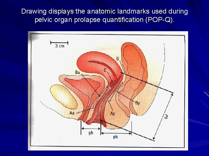 Drawing displays the anatomic landmarks used during pelvic organ prolapse quantification (POP-Q). 