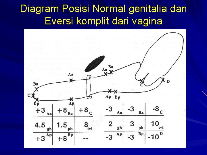 Diagram Posisi Normal genitalia dan Eversi komplit dari vagina 