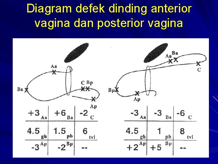 Diagram defek dinding anterior vagina dan posterior vagina 