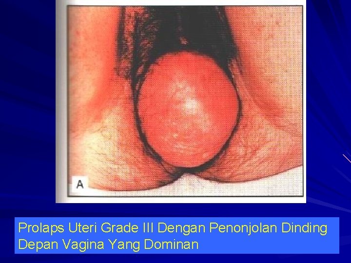 Prolaps Uteri Grade III Dengan Penonjolan Dinding Depan Vagina Yang Dominan 