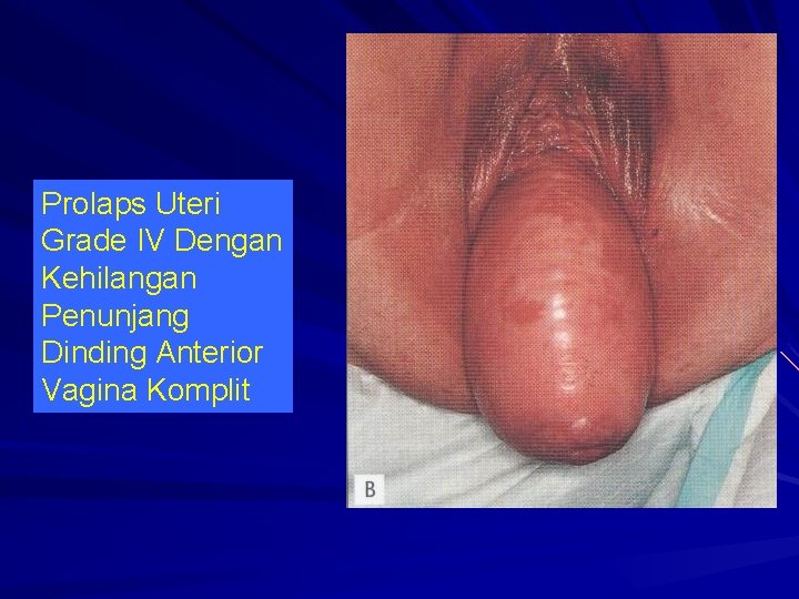 Prolaps Uteri Grade IV Dengan Kehilangan Penunjang Dinding Anterior Vagina Komplit 
