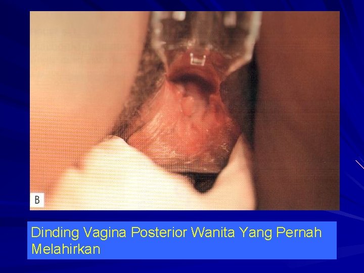 Dinding Vagina Posterior Wanita Yang Pernah Melahirkan 