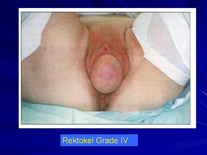 Rektokel Grade IV 