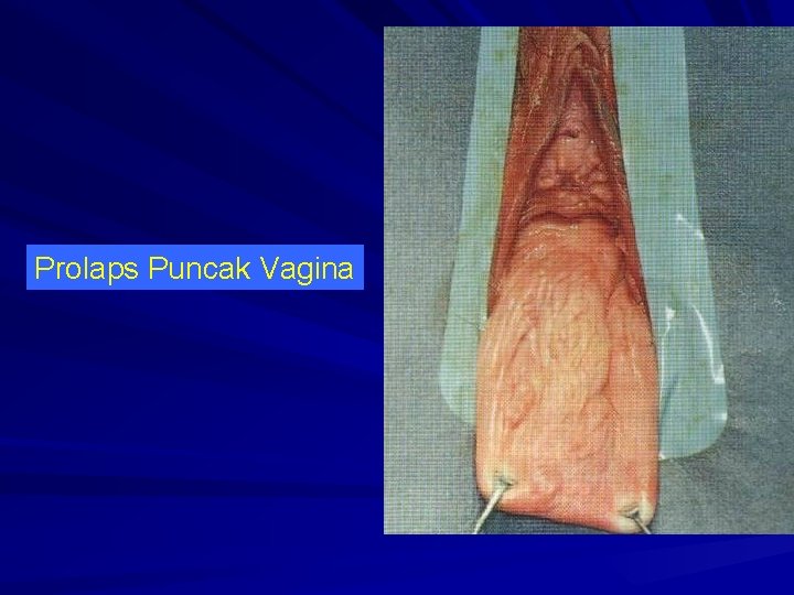 Prolaps Puncak Vagina 