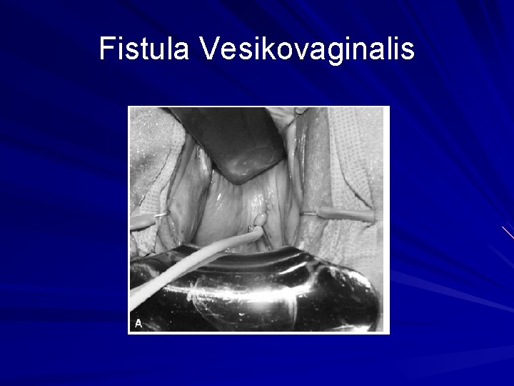 Fistula Vesikovaginalis 