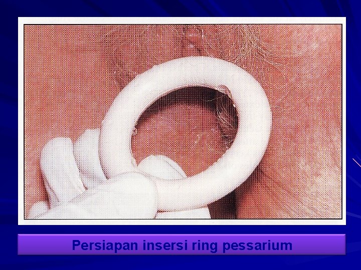 Persiapan insersi ring pessarium 