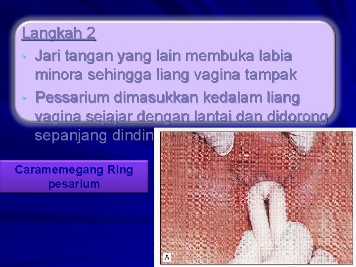 Langkah 2 • Jari tangan yang lain membuka labia minora sehingga liang vagina tampak