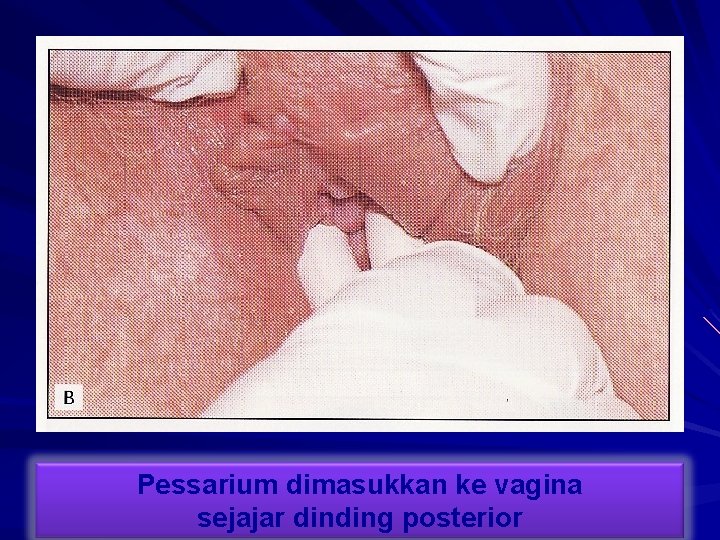 Pessarium dimasukkan ke vagina sejajar dinding posterior 