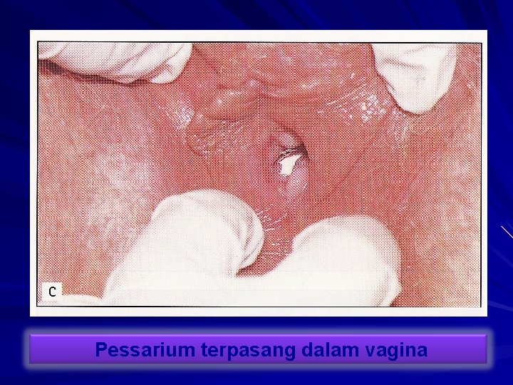 Pessarium terpasang dalam vagina 