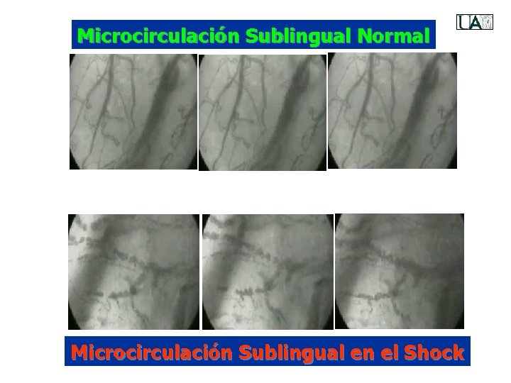 Microcirculación Sublingual Normal Microcirculación Sublingual en el Shock 