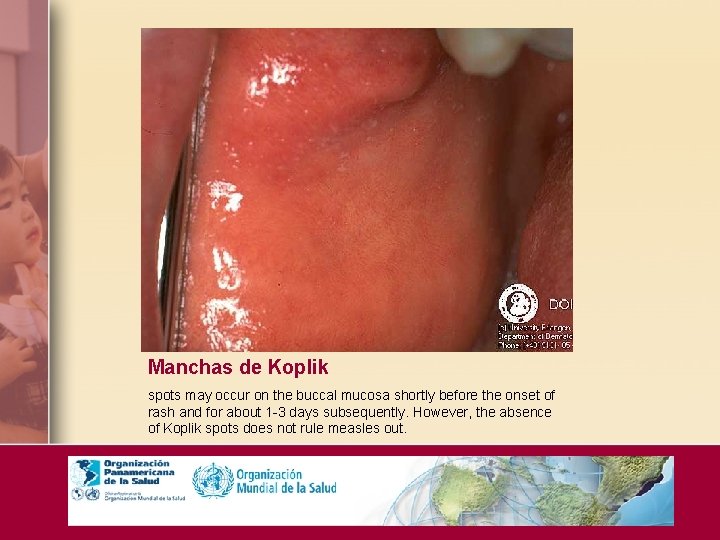 Manchas de Koplik spots may occur on the buccal mucosa shortly before the onset