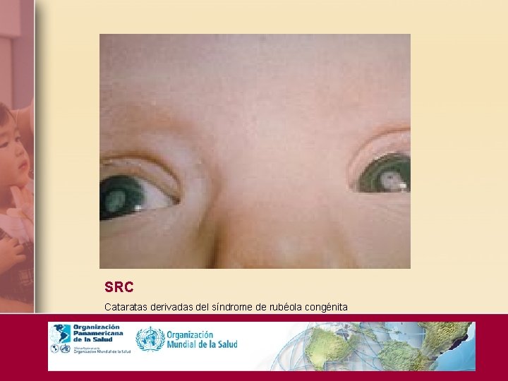 SRC Cataratas derivadas del síndrome de rubéola congénita 