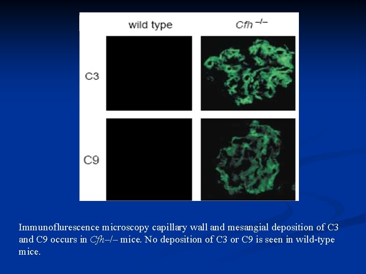 Immunoflurescence microscopy capillary wall and mesangial deposition of C 3 and C 9 occurs