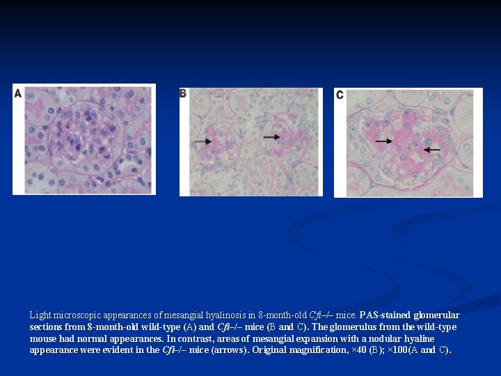 Light microscopic appearances of mesangial hyalinosis in 8 -month-old Cfi–/– mice. PAS-stained glomerular sections