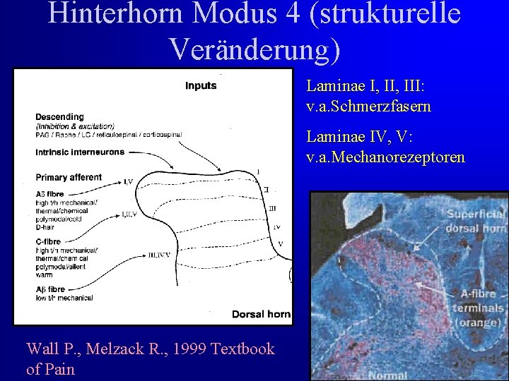Hinterhorn Modus 4 (strukturelle Veränderung) Laminae I, III: v. a. Schmerzfasern Laminae IV, V: