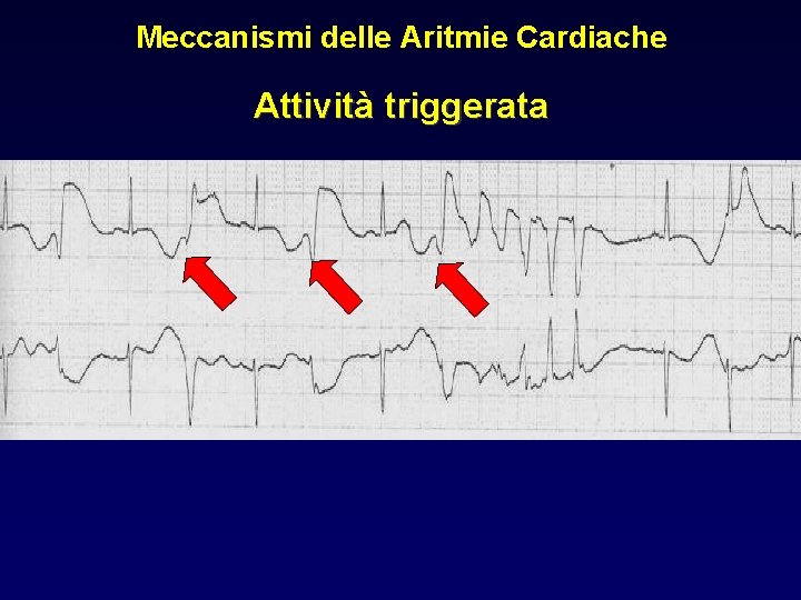 Meccanismi delle Aritmie Cardiache Attività triggerata 