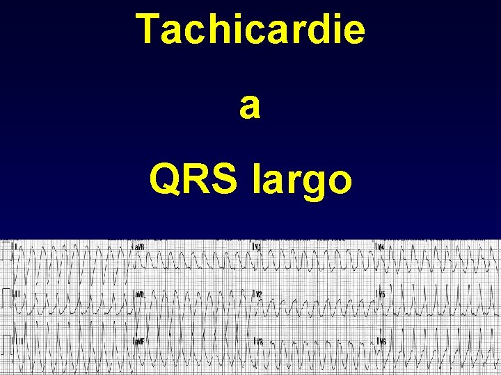 Tachicardie a QRS largo 