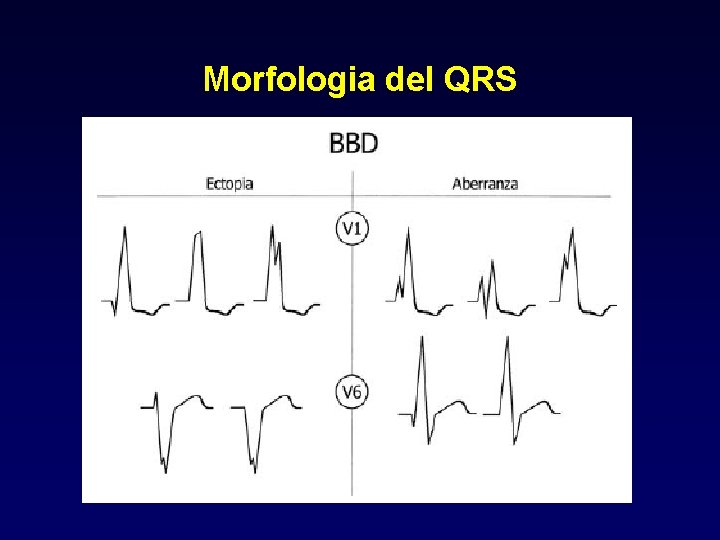 Morfologia del QRS 