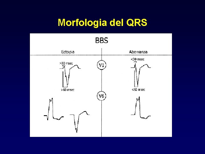 Morfologia del QRS 
