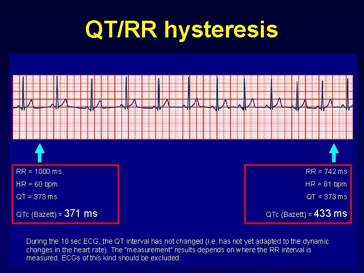 QT/RR hysteresis RR = 1000 ms RR = 742 ms HR = 60 bpm