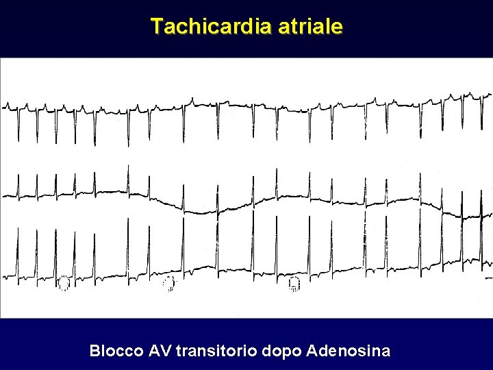 Tachicardia atriale Blocco AV transitorio dopo Adenosina 